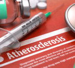 צנתור עורקי רגליים - תמונת אווירה